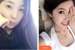 蚌埠華美整形美容門診部閆路整形價(jià)格表附金屬托槽矯正案例展示