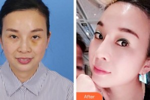 蚌埠韓美美萊醫(yī)療美容門診部歷芳整形價(jià)格表附埋線提升案例展示