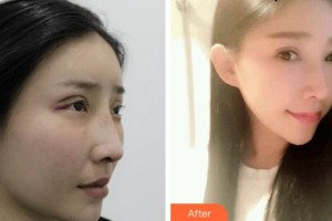 淮南麗都醫(yī)療美容診所張鵬整形價格表附切開雙眼皮案例展示