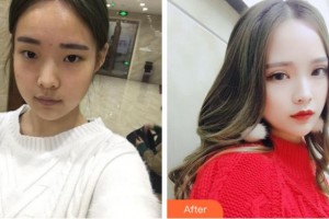 淮南華廈眼科醫(yī)院李波整形價(jià)格表附切開雙眼皮案例展示