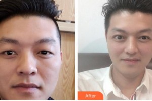淮南華廈眼科醫(yī)院何曉勇整形價(jià)格表附切開雙眼皮案例展示