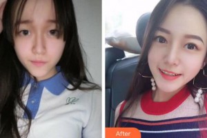 淮南新華醫(yī)院眼科江軍整形價(jià)格表附切開雙眼皮案例展示