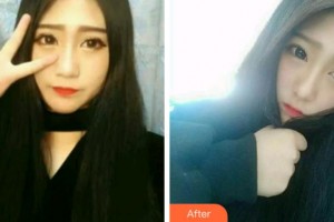 淮南安美口腔門診部楊博翰整形價(jià)格表附牙齒隱形矯正案例展示