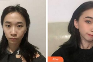 淮北東方美萊塢醫(yī)療美容醫(yī)院崔應鈺整形價格表附微創(chuàng)疤痕修復案例展示