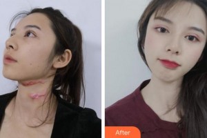 淮北時(shí)光整形美容醫(yī)院劉慧整形價(jià)格表附微創(chuàng)疤痕修復(fù)案例展示