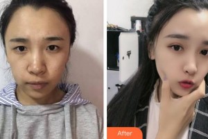 淮北東方美萊塢醫(yī)療美容醫(yī)院康永為整形價(jià)格表附眼部綜合案例展示