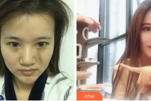 安慶亞星醫(yī)療美容門診部劉佩欣整形價格表附祛疤案例展示