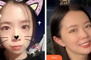 宿州利美口腔診所何艷玲整形價(jià)格表附金屬托槽矯正案例展示