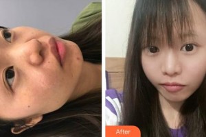 六安市第二人民醫(yī)院燒傷整形科丁美軍整形價(jià)格表附祛疤案例展示