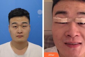 六安瑞視眼科醫(yī)院劉玉整形價(jià)格表附眼部整形案例展示