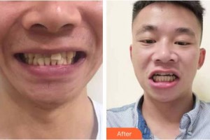 亳州郭琳口腔診所肖明慧整形價(jià)格表附牙齒隱形矯正案例展示