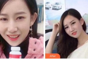 亳州嚴(yán)秀口腔診所嚴(yán)秀整形價(jià)格表附牙齒隱形矯正案例展示