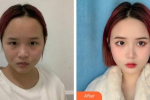 池州伊尚美醫(yī)療美容門診部孫開全整形價(jià)格表附激光美膚祛斑案例展示