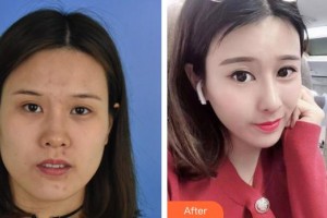 池州伊尚美醫(yī)療美容門(mén)診部江啟富整形價(jià)格表附鼻部綜合案例展示