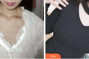 浙江綠城醫(yī)院整形美容中心丁路整形價格表附假體隆胸案例展示