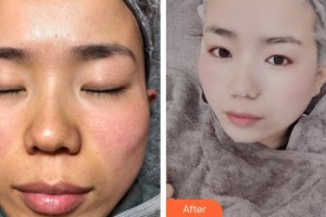 浙江大學醫(yī)學院附屬第二醫(yī)院整形科陶志平整形價格表附祛斑案例展示