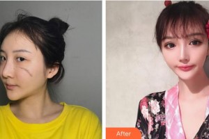 浙江大學醫(yī)學院附屬第二醫(yī)院整形科邵哲人整形價格表附激光祛疤案例展示