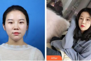 浙江大學醫(yī)學院附屬第二醫(yī)院整形科余建新整形價格表附鼻部綜合案例展示