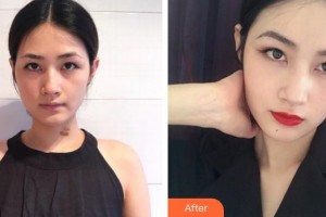 浙江大學醫(yī)學院附屬第二醫(yī)院整形科胡學慶整形價格表附微創(chuàng)疤痕修復案例展示