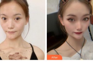 浙江省中醫(yī)院整形美容中心余土根整形價格表附微創(chuàng)疤痕修復案例展示