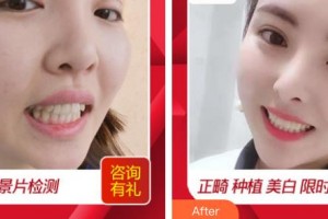 浙江大學醫(yī)學院附屬口腔醫(yī)院王慧明整形價格表附貴金屬烤瓷牙案例展示