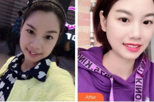 浙江大學醫(yī)學院附屬口腔醫(yī)院傅柏平整形價格表附金屬托槽矯正案例展示