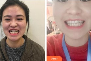 浙江大學醫(yī)學院附屬口腔醫(yī)院胡濟安整形價格表附牙齒隱形矯正案例展示