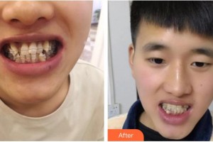 浙江大學(xué)醫(yī)學(xué)院附屬口腔醫(yī)院楊國利整形價格表附隱形托槽矯正案例展示