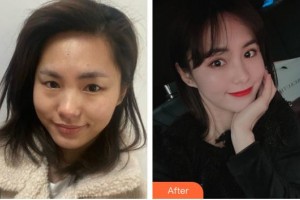 浙江省眼科醫(yī)院方愛武整形價(jià)格表附眼部整形案例展示