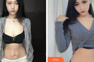 杭州華山連天美醫(yī)療美容整形醫(yī)院高俊明整形價(jià)格表附激光祛疤案例展示