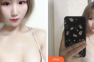 杭州時(shí)光醫(yī)療美容醫(yī)院呂敏整形價(jià)格表附自體脂肪隆胸案例展示