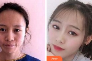 杭州昕微整形美容醫(yī)院雷小燕整形價(jià)格表附埋線提升案例展示