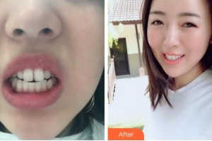 杭州時(shí)光醫(yī)療美容醫(yī)院陳義忠整形價(jià)格表附金屬托槽矯正案例展示