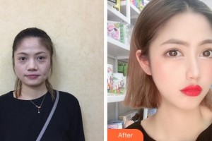 杭州愛琴海醫(yī)療美容醫(yī)院李華整形價(jià)格表附埋線提升案例展示