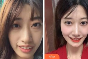 杭州協(xié)友口腔門診部錢小麗整形價(jià)格表附牙齒陶瓷矯正案例展示
