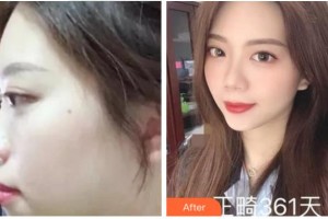 杭州品凱口腔醫(yī)院李建家整形價格表附金屬托槽矯正案例展示