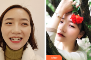 惠州白天鵝口腔醫(yī)院鞠遠(yuǎn)福整形價(jià)格表附隱形矯正案例展示