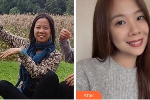 杭州維信口腔門(mén)診部古新月整形價(jià)格表附金屬托槽矯正案例展示