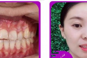 杭州良渚口腔門(mén)診部方豪整形價(jià)格表附牙齒隱形矯正案例展示
