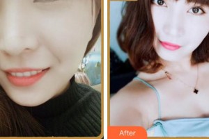 寧波珈禾整形?？漆t(yī)院金正旺整形價(jià)格表附眼部綜合案例展示