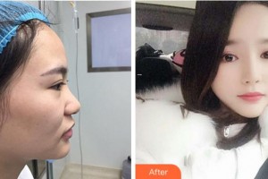 寧波珈禾整形?？漆t(yī)院龔濤整形價(jià)格表附鼻部綜合案例展示