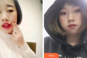 寧波珈禾整形專科醫(yī)院蘇侃整形價(jià)格表附根管調(diào)節(jié)案例展示