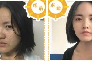 寧波美萊整形美容醫(yī)院李亮整形價(jià)格表附埋線提升案例展示