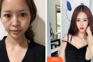 寧波壬美醫(yī)療美容醫(yī)院楊名整形價(jià)格表附鼻部綜合案例展示