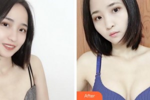 寧波珈禾整形?？漆t(yī)院鄧小榮整形價格表附自體脂肪隆胸案例展示