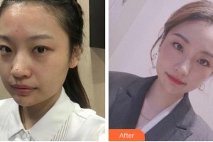 寧波市婦女兒童醫(yī)院醫(yī)學美容科黃應整形價格表附激光祛斑案例展示