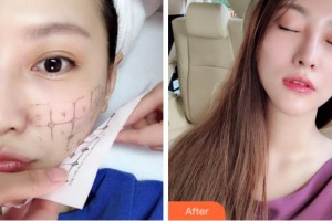 寧波陳標(biāo)新整形美容醫(yī)院金承元整形價格表附熱瑪吉案例展示