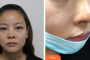 寧波復(fù)大皮膚病?？漆t(yī)院江海鵬整形價格表附鼻部綜合案例展示