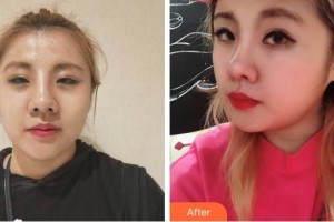 寧波復大皮膚病?？漆t(yī)院王安平整形價格表附熱瑪吉案例展示
