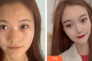 深圳瑞芙臣醫(yī)療美容門診部劉顏顏整形價(jià)格表附鼻部手術(shù)案例展示